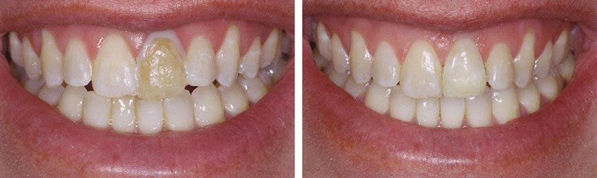 The image shows two close-up views of a person s teeth with yellow stains, likely for dental care purposes.