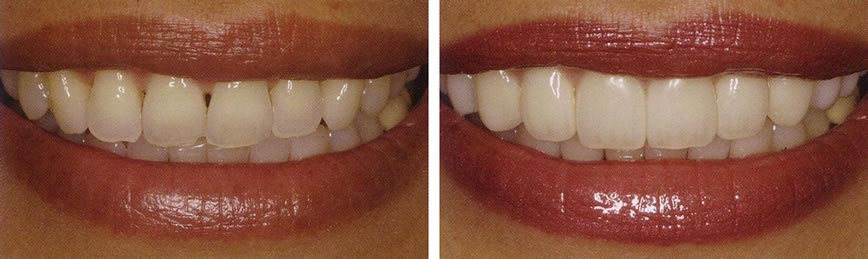 The image shows two close-up photos side by side of a person s teeth, displaying both natural and cosmetic dental treatments.